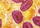 Another Mpox Case Surfaces In Khyber Pakhtunkhwa